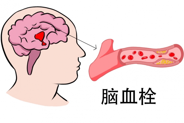 血栓的症状是什么