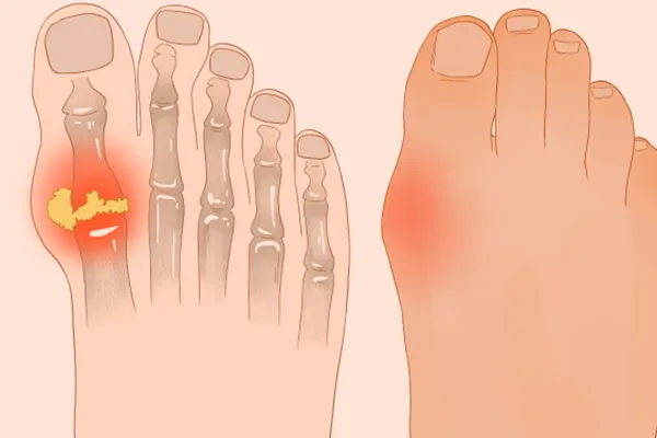 痛风能吃板栗吗