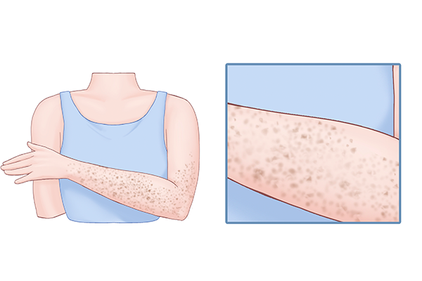 艾滋病的主要症状